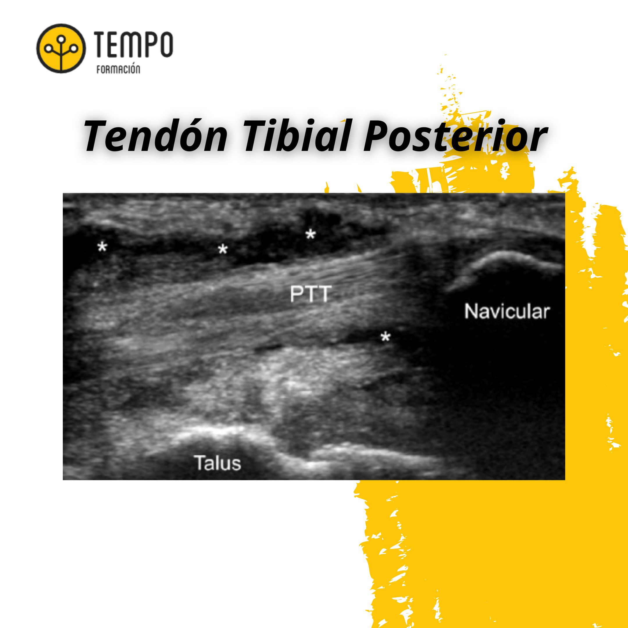 Tendon tibial posterior tempo formacion.png